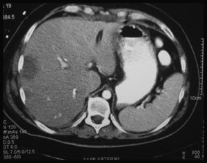 TC urgente realizada tras la reintervención para suturar la rotura de la arteria hepática derecha, donde se observa necrosis del lóbulo hepático derecho anatómico.