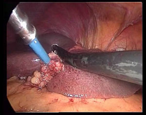 Ecografía intraoperatoria.