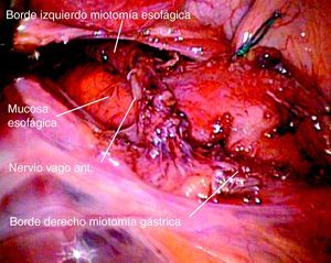 Imagen del campo quirúrgico en que se aprecia la miotomía completada, con preservación del nervio vago anterior.