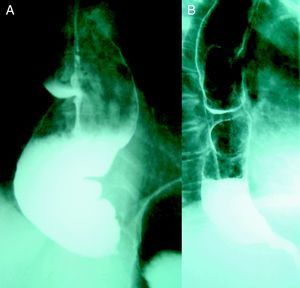 A) Esófago sigmoideo con estenosis ahusada del vestíbulo esófago-gástrico y retención de alimentos en la luz esofágica. B) Dos meses después de la intervención quirúrgica ha disminuido el grado de dilatación y tortuosidad y el resultado clínico es bueno.
