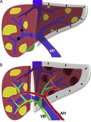 A) Hipertrofia hepática contralateral luego de ligadura o embolización portal. B) Técnica quirúrgica de hepatectomía en dos tiempos con partición hepática in situ conservando únicamente la vascularización arterial y el drenaje suprahepático del hígado derecho. Con el nuevo método se reportaron incrementos del remanente hepático futuro de 40 a 160% en 6 días. AH: arteria hepática; VB: vía biliar; VP: vena porta.