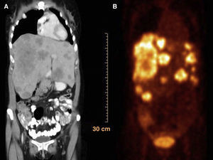 A) Imagen tomográfica que demuestra parénquima hepático reemplazado por lesiones compatibles con metástasis. B) PET que confirma hiperactividad metabólica múltiple en hígado.