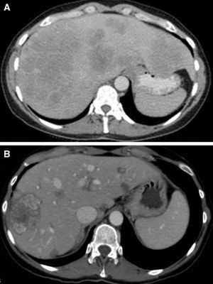 Reestadificación tomográfica. A) Tomografía previa a la quimioterapia. B) Control postneoadyuvancia que demuestra respuesta significativa con disminución del número y tamaño de las metástasis hepáticas.