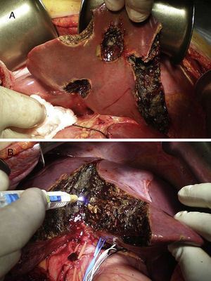 Fotografías intraoperatorias. A) Resección de metástasis en el hígado izquierdo. B) Transección hepática.