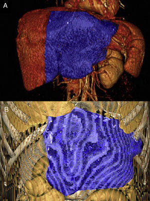 A) Volumetría hepática preoperatoria de 492ml. B) Volumen de 690ml al 6.° día postoperatorio.