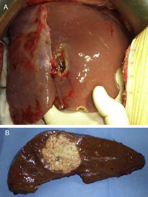 A) Remanente hepático hipertrofiado, crecimiento mayor al 40% al 7.° día. B) Pieza quirúrgica de hepatectomía derecha.
