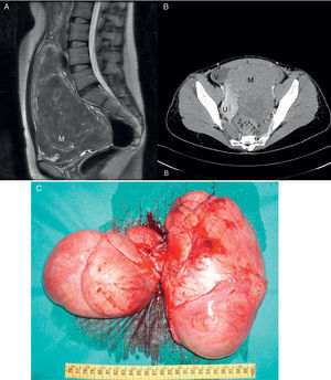 A: corte sagital de resonancia magnética que muestra gran masa abdominal. B: tomografía computarizada que muestra una masa gigante (M) que desplaza útero (U) y vejiga (V). C: imagen macroscópica de la tumoración abdominal de bordes bien definidos de 26 cm de diámetro y multilobulada.