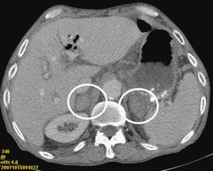 Imagen de hemorragia suprarrenal bilateral postquirúrgica.