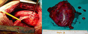 Invasión del nervio frénico (referenciado a la izquierda con loop) por la tumoración. Pieza quirúrgica.
