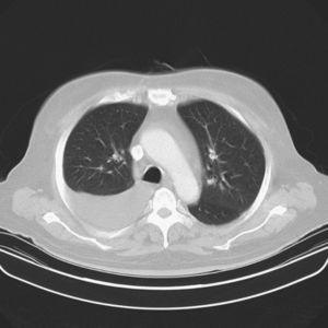 Derrame pleural bilateral, derrame pericárdico, ascitis.