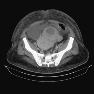 Leiomiosarcoma de cordón a nivel inguinal izquierdo.
