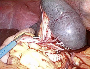 Imagen intraoperatoria por vía laparoscópica. Esplenomegalia con torsión del hilio esplénico (flecha).