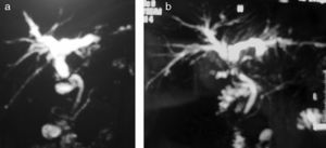Imagen de colangiorresonancia magnética: a) Estenosis anastomótica corta sin barro biliar. b) Estenosis anastomótica con molde biliar supraanastomótico.