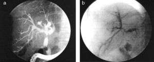 Imagen de colangiorresonancia magnética: a) Estenosis no anastomótica tipo hiliar. b) Estenosis anastomótica tipo difuso.