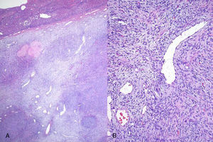 Imágenes microscópicas del tumor. Hematoxilina eosina.
