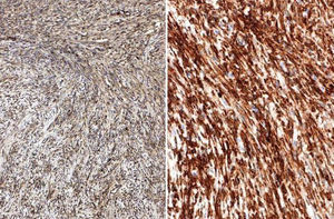 Inmunohistoquímica A) IGF II; B) CD34.