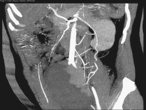 TC abdominal con cuatro arterias renales izquierdas y dos derechas, un origen común de las arterias hepática y mesentérica superior y una arteria iliaca interna izquierda con salida en posición distal. Tronco celiaco compuesto por una arteria gástrica izquierda y una arteria esplénica de gran longitud que irriga a un bazo localizado a nivel pélvico, con múltiples infartos isquémicos. A la altura de la cola del páncreas, se observa la imagen de torsión de la arteria esplénica.