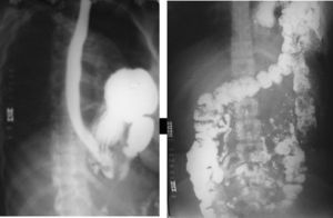Radiografías contrastadas muestran órganos abdominales en el hemitórax izquierdo.