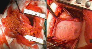 Órganos abdominales en el tórax y reparación del defecto con malla.