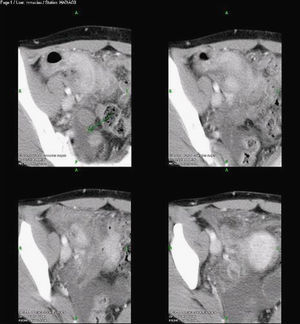 TC abdominopélvica que muestra cambios inflamatorios en íleon distal y ciego, así como cambios inflamatorios significativos en la grasa pericolónica.