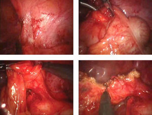 Imágenes del procedimiento quirúrgico que muestran el apéndice vermiforme, con proceso inflamatorio severo, fibrosis intensa y eritema.