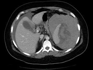 Hematoma subcapsular esplénico (16 x 13cm).