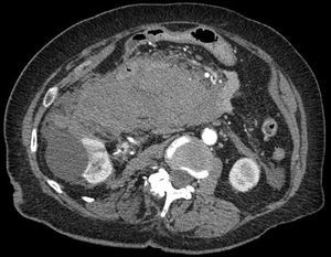 Hematoma retroperitoneal (20 x 7cm).