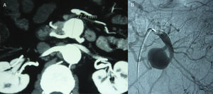 A) Estudio CT preoperatorio de aneurisma de arteria yeyunal. B) Arteriografía selectiva e intento de embolización.