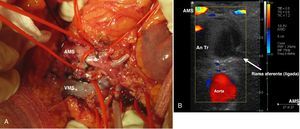 A) Control intraoperatorio de arteria mesentérica superior y sus ramas. B) Localización con eco-doppler de las ramas aferente y eferente y comprobación de la exclusión del aneurisma al ligarlas.
