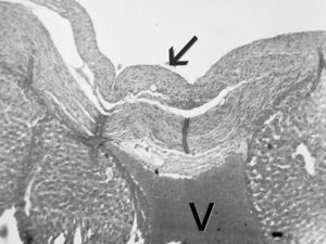 Corte histológico (hematoxilina eosina, 40×). La flecha indica el tejido fibroso, sin células epiteliales (la luz es un artefacto de técnica). La V marca una vena suprahepática.