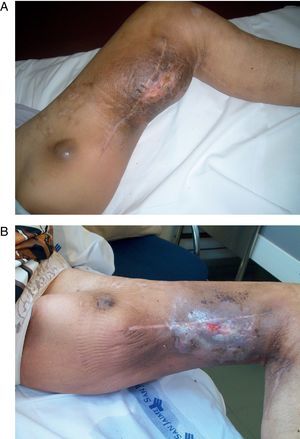 Paciente con melanoma de miembro inferior izquierdo. A) se observa la gran tumoración preoperatoria con una metástasis de menor tamaño en la parte superior. B) A los 3 meses de realizada la perfusión aislada de la extremidad con TNF, melfalán e hipertermia se aprecia la desaparición de las masas tumorales.