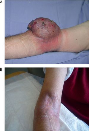 Paciente con melanoma en miembro superior derecho: A) aspecto preoperatorio de la masa tumoral. B) a los 4 meses de la perfusión del miembro.