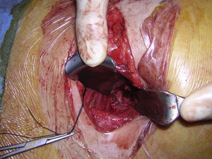 Técnica de mini–open anterior spine surgery (infraumbilical extraperitoneal).