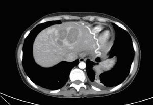 TAC de abdomen: Lesión heterogénea con áreas de hemorragia y gran circulación colateral.