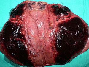 Pieza quirúrgica: lesión polilobulada y bien delimitada complicada con áreas hemorragia intratumoral.