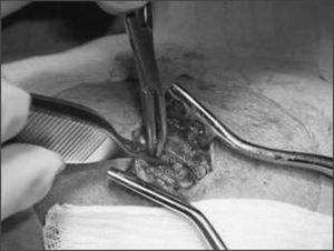Detalle del alotrasplante de tejido paratiroideo en un bolsillo muscular del antebrazo del receptor.