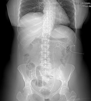 Paciente número 7 de la serie. Se observa en la radiografía de abdomen la presencia de una nefrostomía percutánea izquierda y un catéter doble J posicionado en el acto operatorio tras la reconstrucción del tránsito urinario.