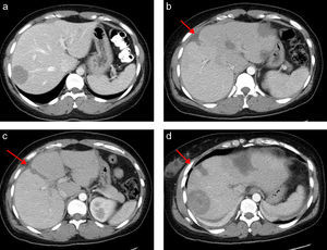 a) Tomografía Computerizada (TC) preoperatoria con un volumen lóbulo izquierdo de 566ml (volumen intraoperatorio calculado tras resección de las metástasis del lóbulo izquierdo de 350ml). b, c y d) TC al 7° día postoperatorio con un volumen lóbulo izquierdo de 790ml. La flecha señala la línea del torniquete. Se observa un área hipodensa central correspondiente a radiofrecuencia.