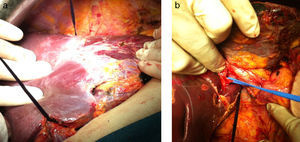 a) Se observa el torniquete pasado con la maniobra de hanging por encima de vena cava inferior. b) Control de vena porta derecha previo a su ligadura y sección. Se observa la ligadura del torniquete emergiendo por vena cava inferior.
