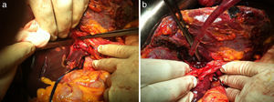 a) Sección de la vena porta derecha. b) Paso de la ligadura del torniquete extraglissoniana para no ocluir la arteria hepática derecha ni la vía biliar derecha.
