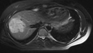 RM con contraste (gadolinio): tumoración hepática subcapsular, heterogénea, multilobulada, hiperintensa en T2 y con áreas de grasa en su interior sugestiva de adenoma. Se aprecia la proximidad de la raíz de la vena suprahepática derecha.