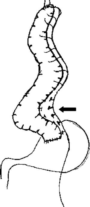 Sección de las ramas terminales de la arcada cólica (flecha).