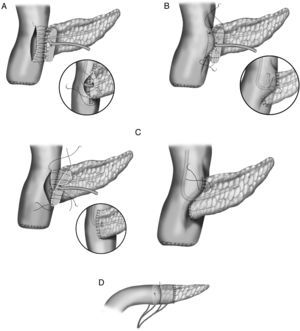 A) pancreaticoyeyunostomía en un solo plano; B) pancreaticoyeyunostomía con anastomosis ducto-mucosa; C) pancreaticoyeyunostomía con la técnica de la invaginación; D) técnica de Peng: una ligadura envuelve el segmento pancreático invaginado en el intestino.