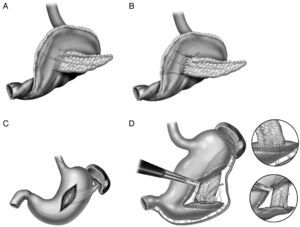 A) anastomosis ducto-mucosa y colocación de un drenaje transanastomótico; B) invaginación de unos 2-3cm del remanente pancreático a través de la cara posterior gástrica; C) invaginación del remanente pancreático a través de la cara posterior gástrica y anastomosis pancreaticogástrica a través de una gastrotomía anterior; D) pancreaticogastrostomía con un segmento de estómago después de una partición gástrica.