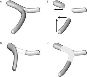 Técnica de reconstrucción vascular en el caso de una resección de un segmento de la vena mesentérica superior y de la unión entre la vena esplénica y la vena porta: A) anatomía esplenomesentérica-porta. B) movilización de la vena mesentérica superior en sentido craneal y de la vena porta en sentido lateral. C) la reconstrucción mesentérico-portal es casi siempre factible pero la vena esplénica no puede anastomosarse al segmento vascular reconstruido. D) la reconstrucción vascular de la vena esplénica puede hacerse con la colocación de un injerto vascular.
