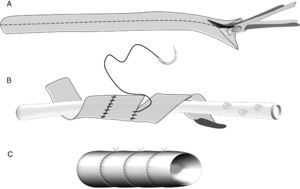 Construcción de un injerto venoso en espiral: A) injerto de vena safena que se abre longitudinalmente. B) reconstrucción de la luz venosa con anastomosis en espiral sobre un tubo de drenaje. C) injerto en espiral.