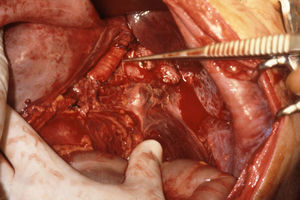 Lesión aórtica suprarrenal secundaria a herida por arma de fuego. Reparación mediante injerto de Dacron.