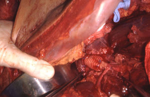 Herida por arma blanca de la aorta suprarrenal. Reparación primaria en el origen de la arteria mesentérica superior.