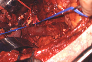 Lesión aórtica irreconstruible en el origen de la arteria mesentérica superior.
