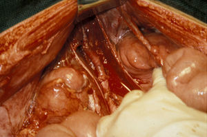 Herida abdominal por arma de fuego. Ligadura del tronco celíaco y reparación de la arteria mesentérica superior.